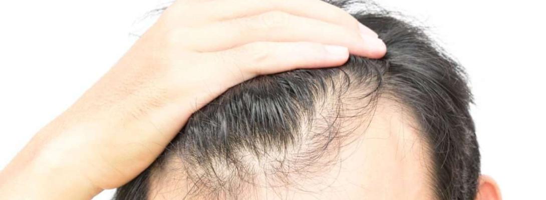 Які продукти запобігають випаданню волосся у чоловіків: рекомендації експертів