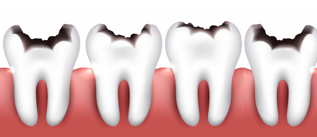 Як назавжди забути про карієс: 5 порад, які допоможуть зберегти ваші зуби здоровими