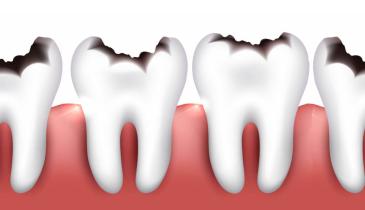 Як назавжди забути про карієс: 5 порад, які допоможуть зберегти ваші зуби здоровими