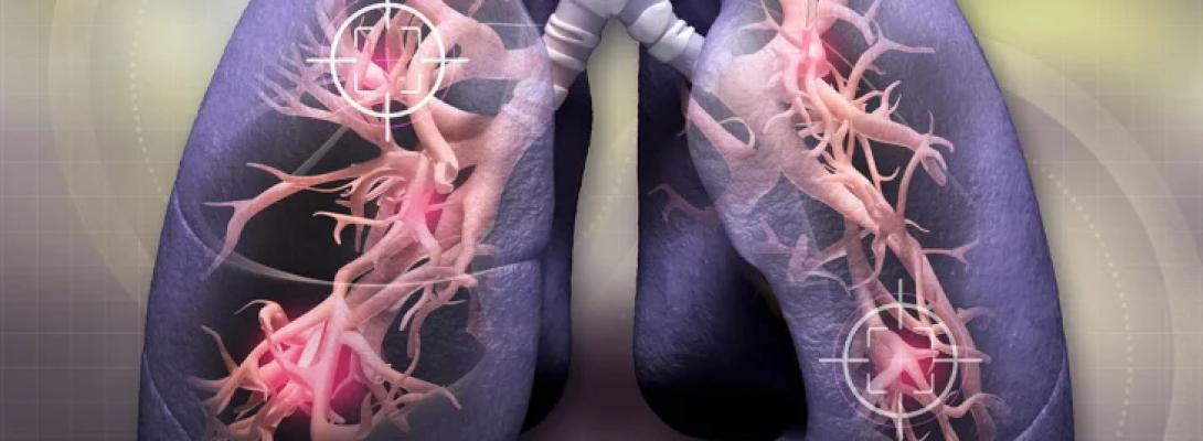Несподівані сигнали: лікарі розповіли, які ранні ознаки раку легень часто ігнорують люди