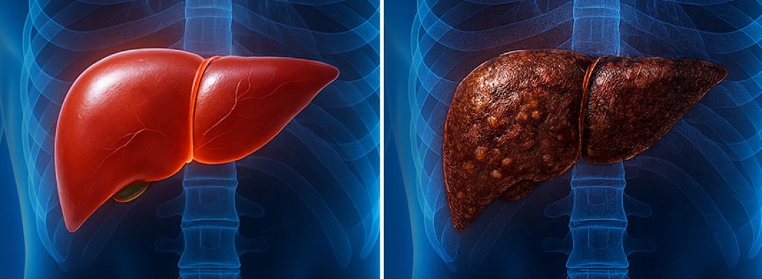 Неочікувана загроза на вашій кухні! Ці продукти можуть вбити вашу печінку