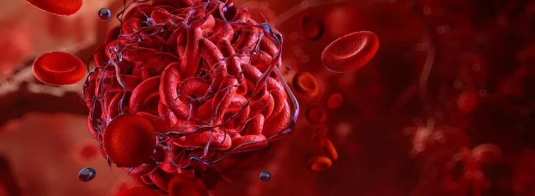 Не ігноруйте сигнали свого тіла: основні тривожні ознаки, які можуть свідчити про тромб