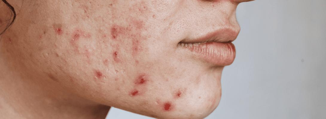 Чого точно не слід робити при лікуванні акне: небезпечні поради, які тільки шкодять шкірі