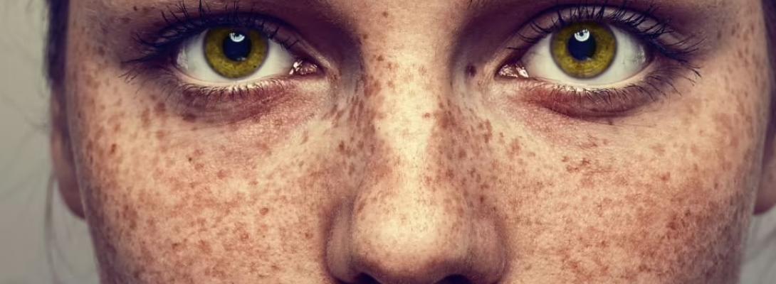 Веснянки у дорослому віці: чому вони можуть сигналізувати про серйозні проблеми