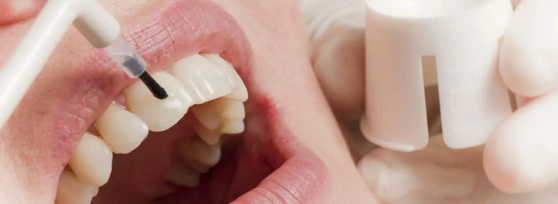 Що справді руйнує вашу зубну емаль: ці продукти і напої завдають найбільшої шкоди зубам