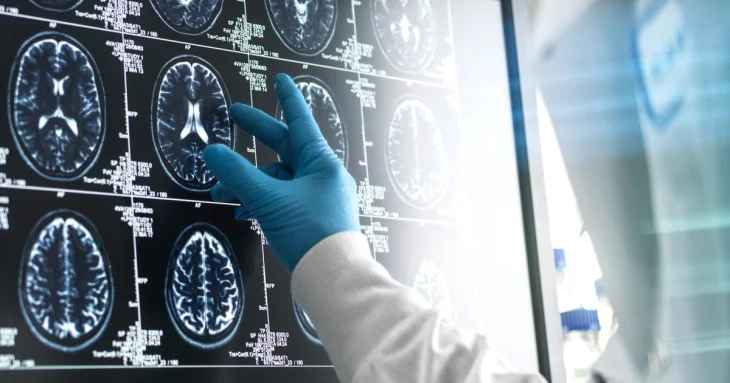 Деменція може проявлятися непомітно: експерти назвали симптоми, які часто ігнорують