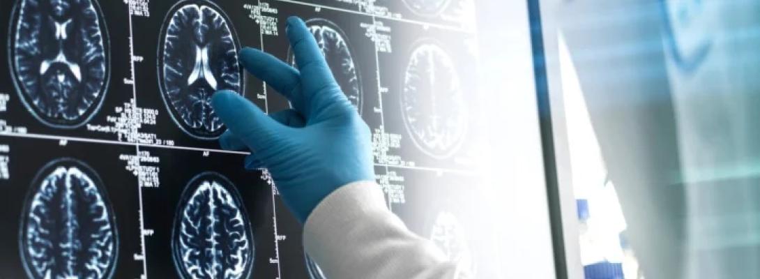 Деменція може проявлятися непомітно: експерти назвали симптоми, які часто ігнорують