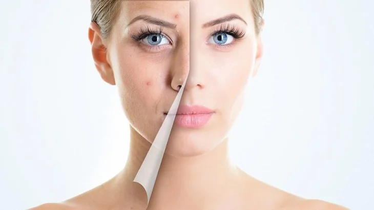 Позбутися прищів простіше, ніж здається: які харчові звички варто змінити вже сьогодні