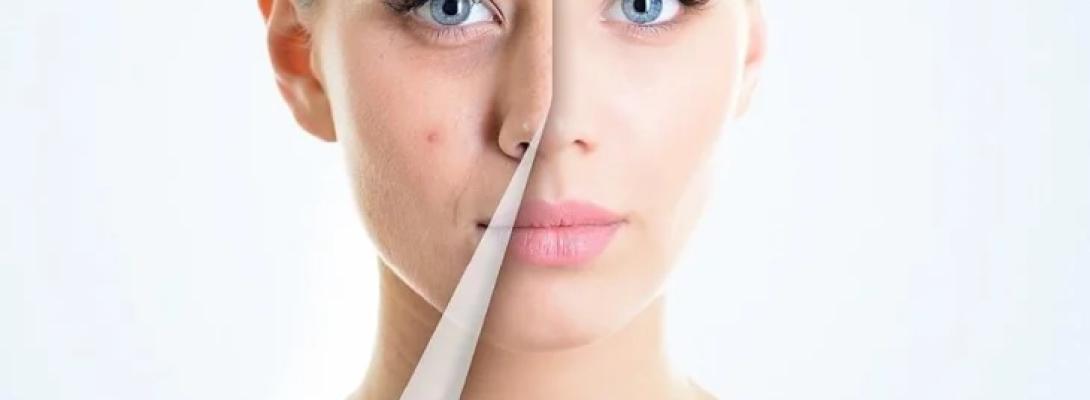 Позбутися прищів простіше, ніж здається: які харчові звички варто змінити вже сьогодні