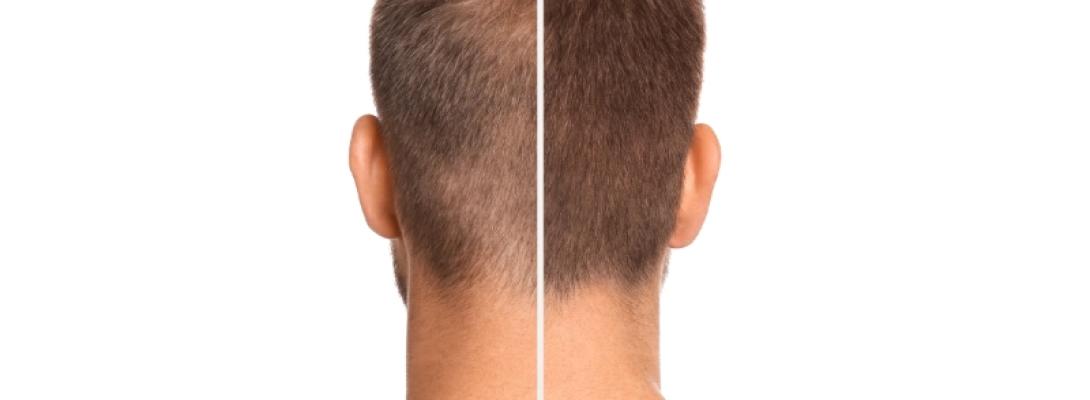 Які продукти допомагають запобігти випаданню волосся у чоловіків: повний список 