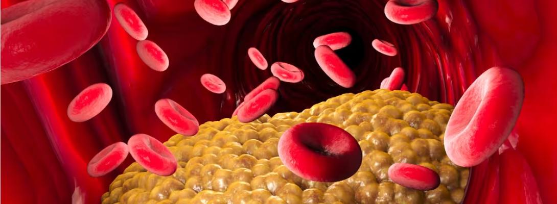 Як розпізнати небезпечний холестерин на ранніх етапах: ознаки, які не можна ігнорувати