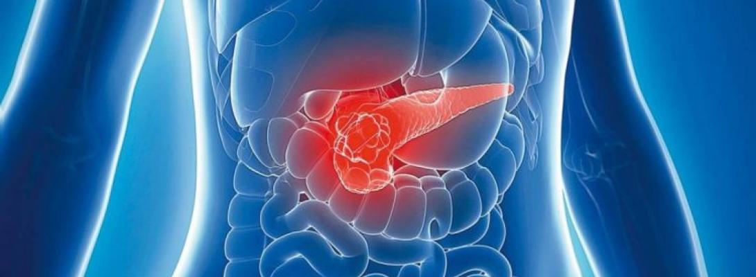 Лікарі попереджають: ці малопомітні симптоми вказують на рак підшлункової залози