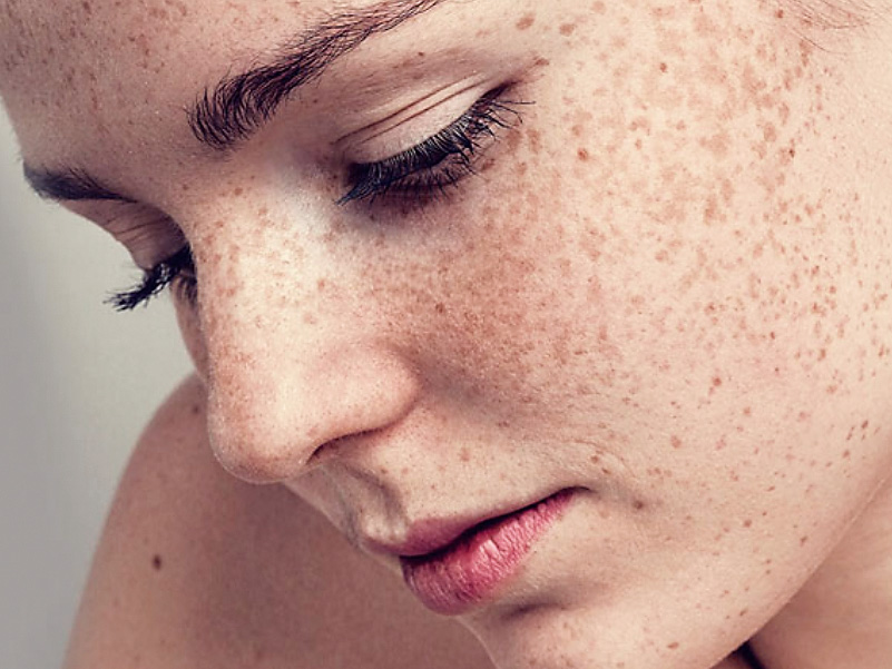 Лікарі попереджають: веснянки у дорослому віці можуть бути небезпечними для здоров’я
