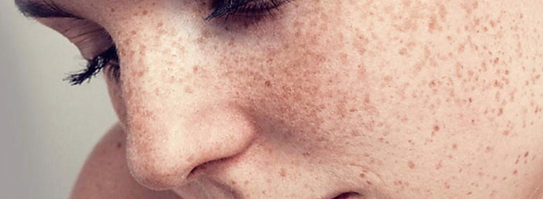 Лікарі попереджають: веснянки у дорослому віці можуть бути небезпечними для здоров’я