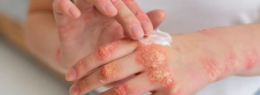 Сучасні харчові звички можуть стати причиною псоріазу: результати нового дослідження